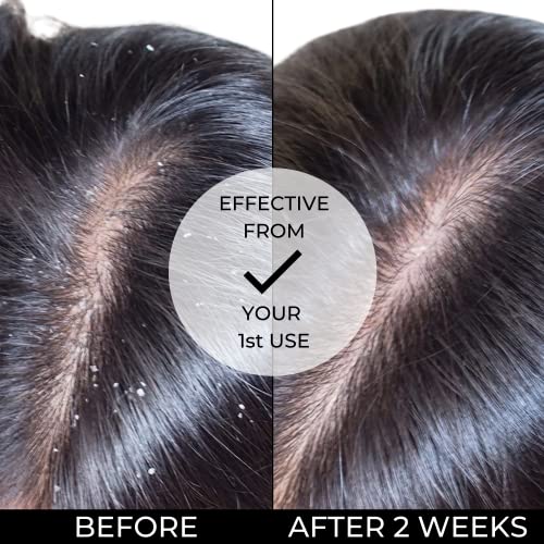 Dandruff Fighting Hair Conditioner Dry Scalp 12 oz Moisturizing Formula - Image 7