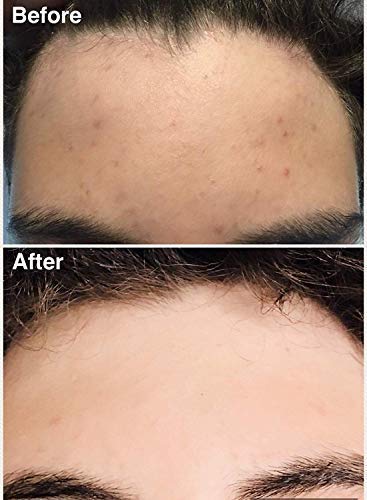 Dandruff Shampoo for Acne Control 12 oz with Flake and Breakout Reduction - Image 4