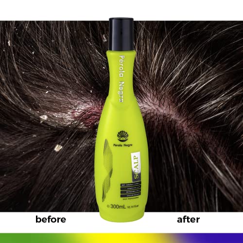 Dandruff Treatment for Healthy Hair - Image 3