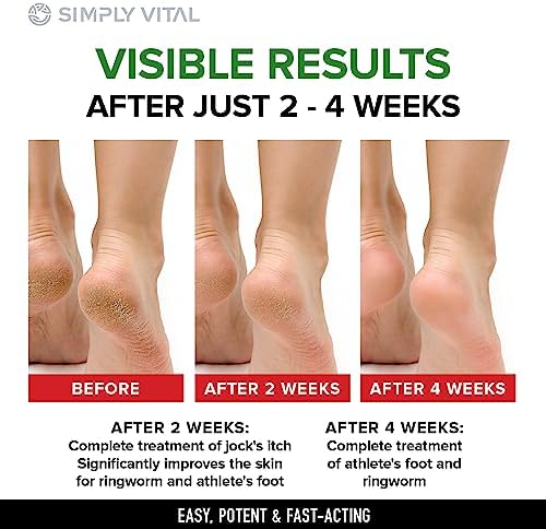 New Fungal Nail Infection Treatment Foot Cream 4 oz for Healthy Feet Care - Image 3