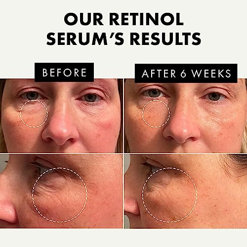 Roc Retinol Eye Cream 0.5 oz with Trusted Reddit User Reviews - Image 3