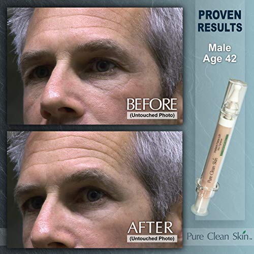 15ml Hydrating Syringe Eye Cream for Dark Circles and Puffiness - Image 6