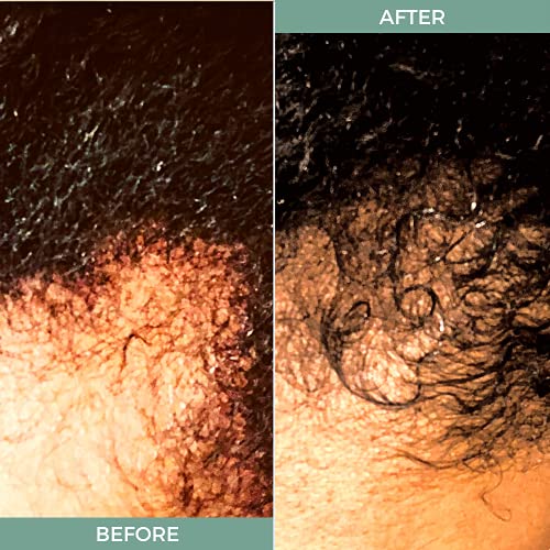 Black Castor Oil for Hair Thinning - Image 4