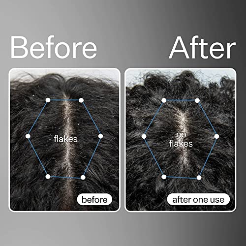 ?Dandruff-fighting Hair Oils for Healthy Scalp? - Image 4