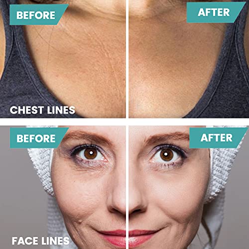 Anti wrinkle injections for under eye area. - Image 7