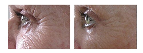 ?Natural Eye Treatments for Anti Aging? - Image 7