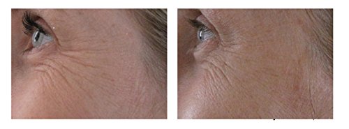 ?Natural Eye Treatments for Anti Aging? - Image 8