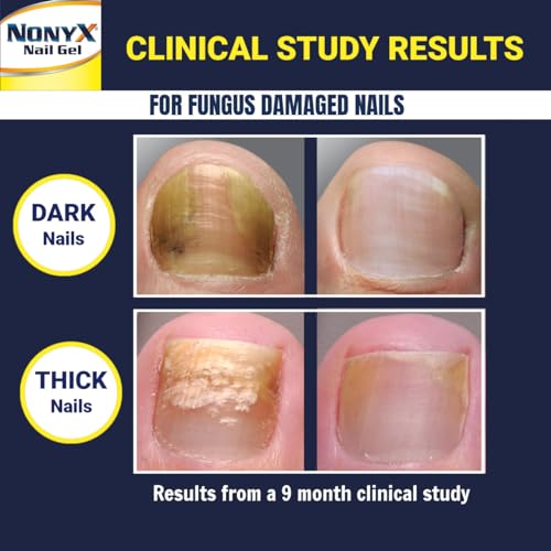 Fungal Nail Clarifying Gel | Rids Nails of Fungus by Removing Keratin Debris Where Nail Fungus Grows | 90% of Toenails Improved Using this Toenail Fungus Treatment | 4 oz - Image 5