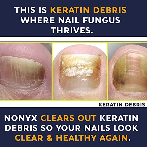Fungal Nail Clarifying Gel | Rids Nails of Fungus by Removing Keratin Debris Where Nail Fungus Grows | 90% of Toenails Improved Using this Toenail Fungus Treatment | 4 oz - Image 8