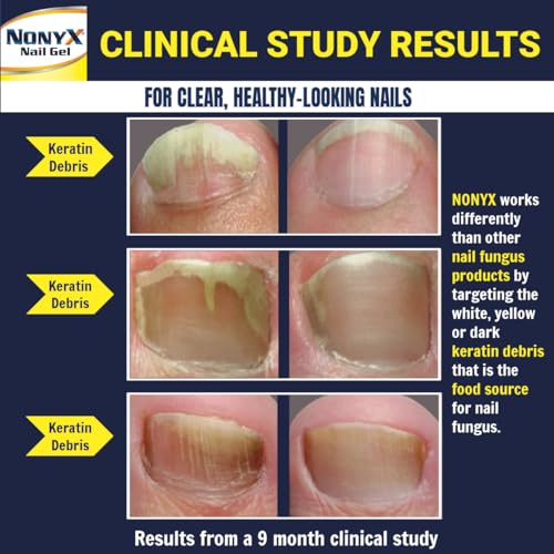 Fungal Nail Clarifying Gel | Rids Nails of Fungus by Removing Keratin Debris Where Nail Fungus Grows | 90% of Toenails Improved Using this Toenail Fungus Treatment | 4 oz - Image 4