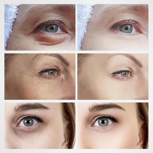 RF Radio Frequency Eye Device | Under Eye Bags Treatment | Eye Bags | Eye Puffiness | Dark Circles | Wrinkle Reducing | Anti Aging Device - 2 in 1 Professional RF Eye Skin Care Beauty Device - Image 4