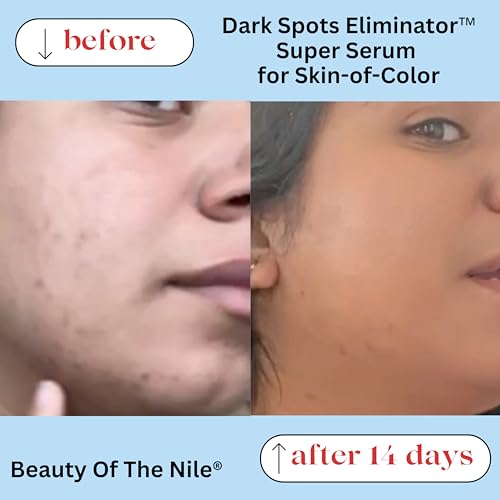 Dark Spots Eliminator™ Serum for Skin-of-Color, Remover Face Hyperpigmentation Age Acne Retinol Niacinamide Hyaluronic Acid, Beauty of the Nile® 1 Oz - Image 4