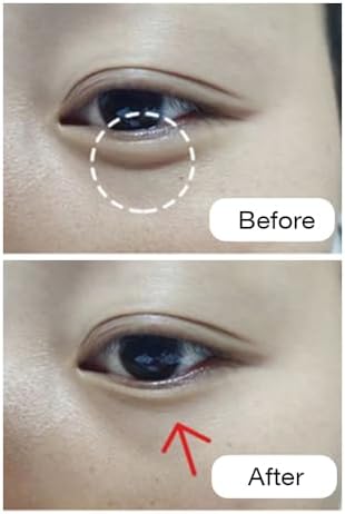 RF Radio Frequency Eye Device | Under Eye Bags Treatment | Eye Bags | Eye Puffiness | Dark Circles | Wrinkle Reducing | Anti Aging Device - 2 in 1 Professional RF Eye Skin Care Beauty Device - Image 3