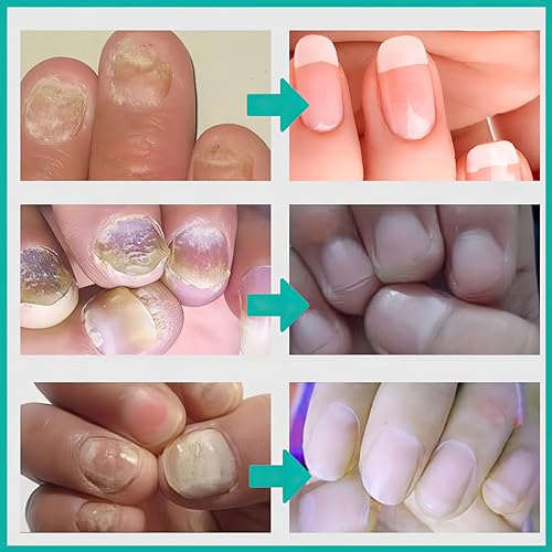 Nail Repair Cream, Nail Strengthener Cream, Nail Repair Solution, Repairs Damaged, Broken, Cracked and Discolored Nails - Image 4