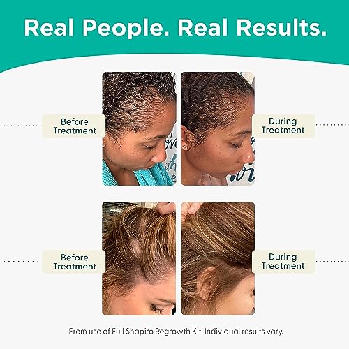 Minoxidil 2% Topical Hair Growth Serum for Women, 3-Month Supply - Image 6