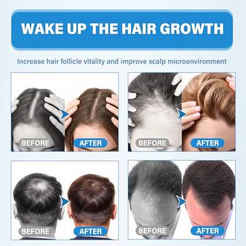 Minoxidil 5% Topical Solution Hair Growth Treatment for Men and Women, Thickens Hair, Stops Loss - Image 6