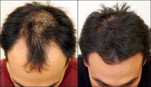 Nutrifolica Hair Loss Treatment & Accelerator - 2 Month Supply - Image 3