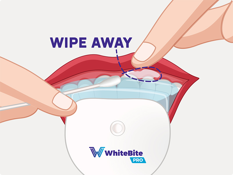 Teeth Whitening Kit