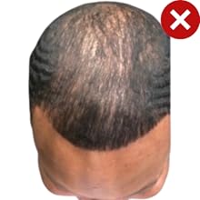front hair line thinning