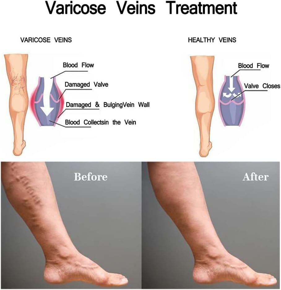Vericose Veins Treatment Blue Light Lazer Treatment Pen,Spider Vein Treatment for Legs,Varicose Veins Blue Light Therapy Set - Image 4
