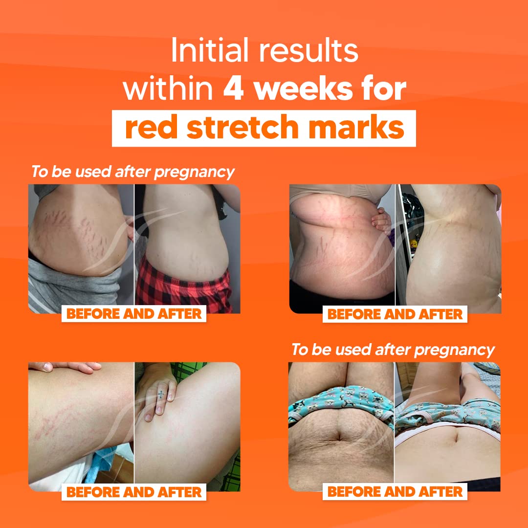 Cicatrissim Deep Stretch Mark Removal Cream - Innovative Formula With Pure and Powerful Natural Ingredients From Brazilian Flora - For All Stretch Marks & Skin Types. - Image 5