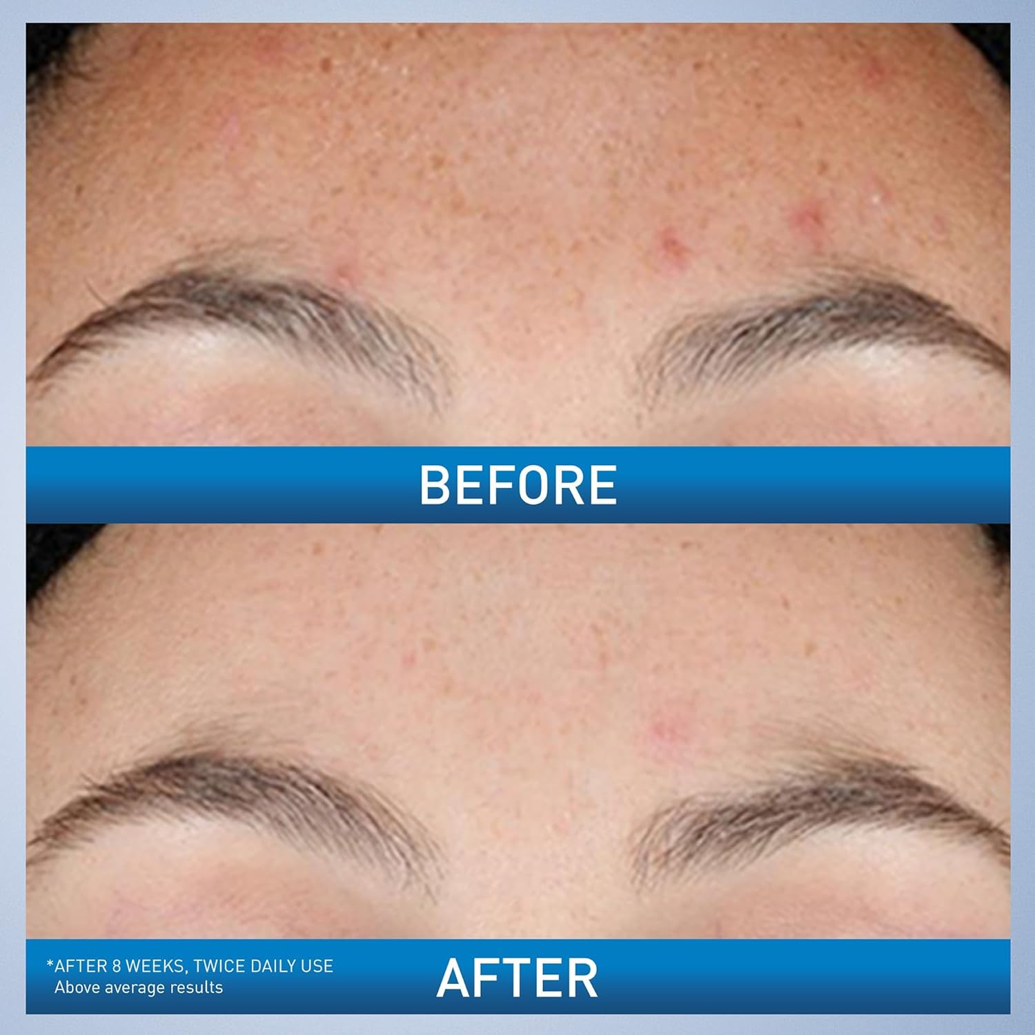 CeraVe Resurfacing Retinol Serum For Post Acne Marks, Formulated With Licorice Root Extract & Niacinamide, Brightening Serum & Pore Minimizer For Face, Post Acne Skin Barrier Repair, Non-Comedogenic - Image 3