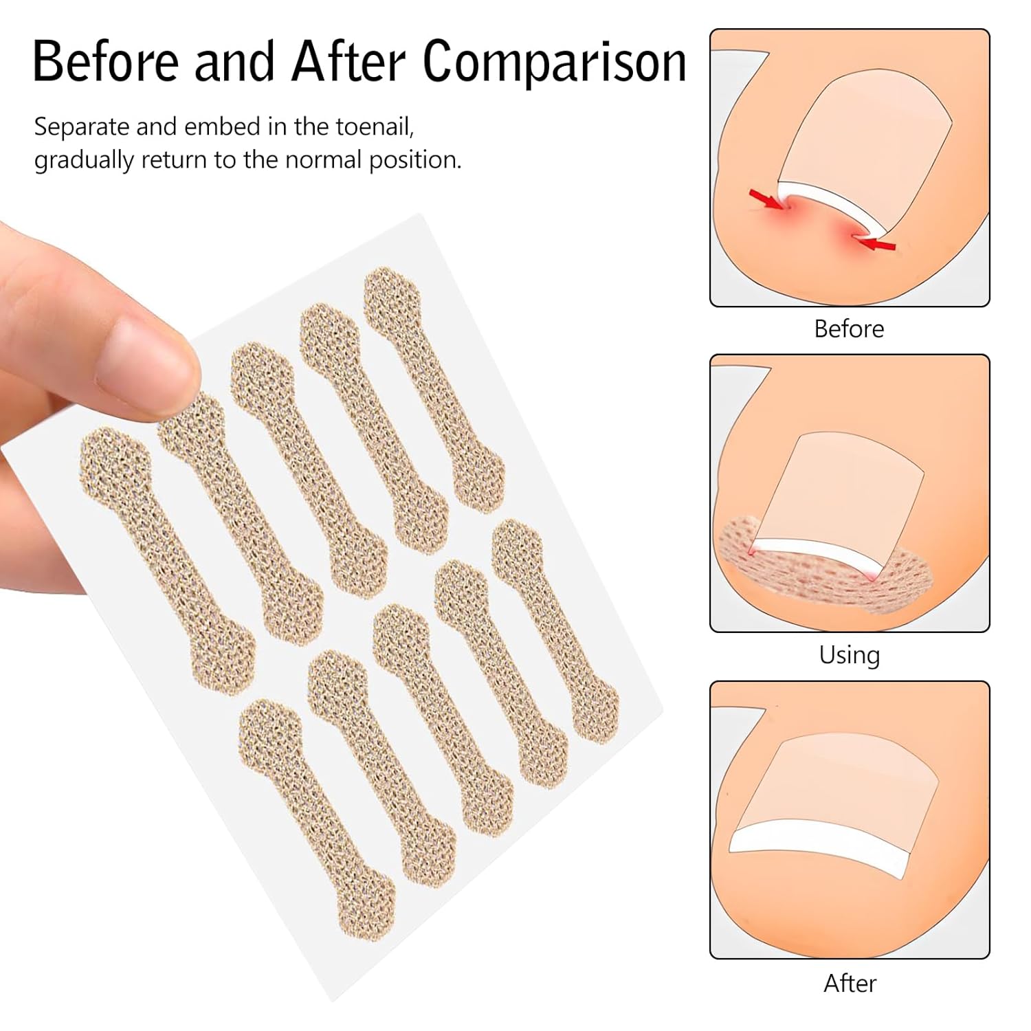 Ingrown Toenail Treatment, 100 Pcs Breathable Ingrown Toenail Strips,Painless Ingrown Toenail Tool, Professional Pedicure for Toenail Corrector Patch - Image 6