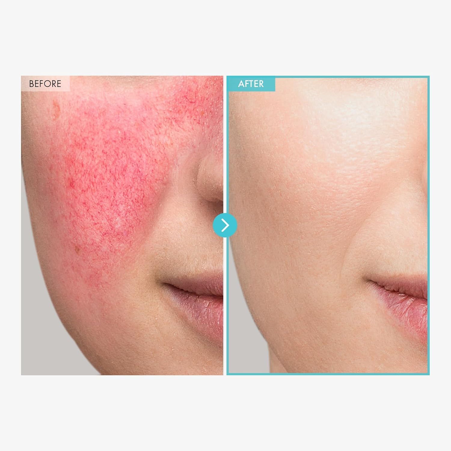 SOS Repair CICA Clinic Zinc Cream, 100,000ppm Zinc Oxide, Heal, Soothe Acne, Redness, Rosacea Treatment, Skin Barrier Repair, Moisture, Non-Comedogenic, Korean Skin care, 50g, 1.76 oz. - Image 3