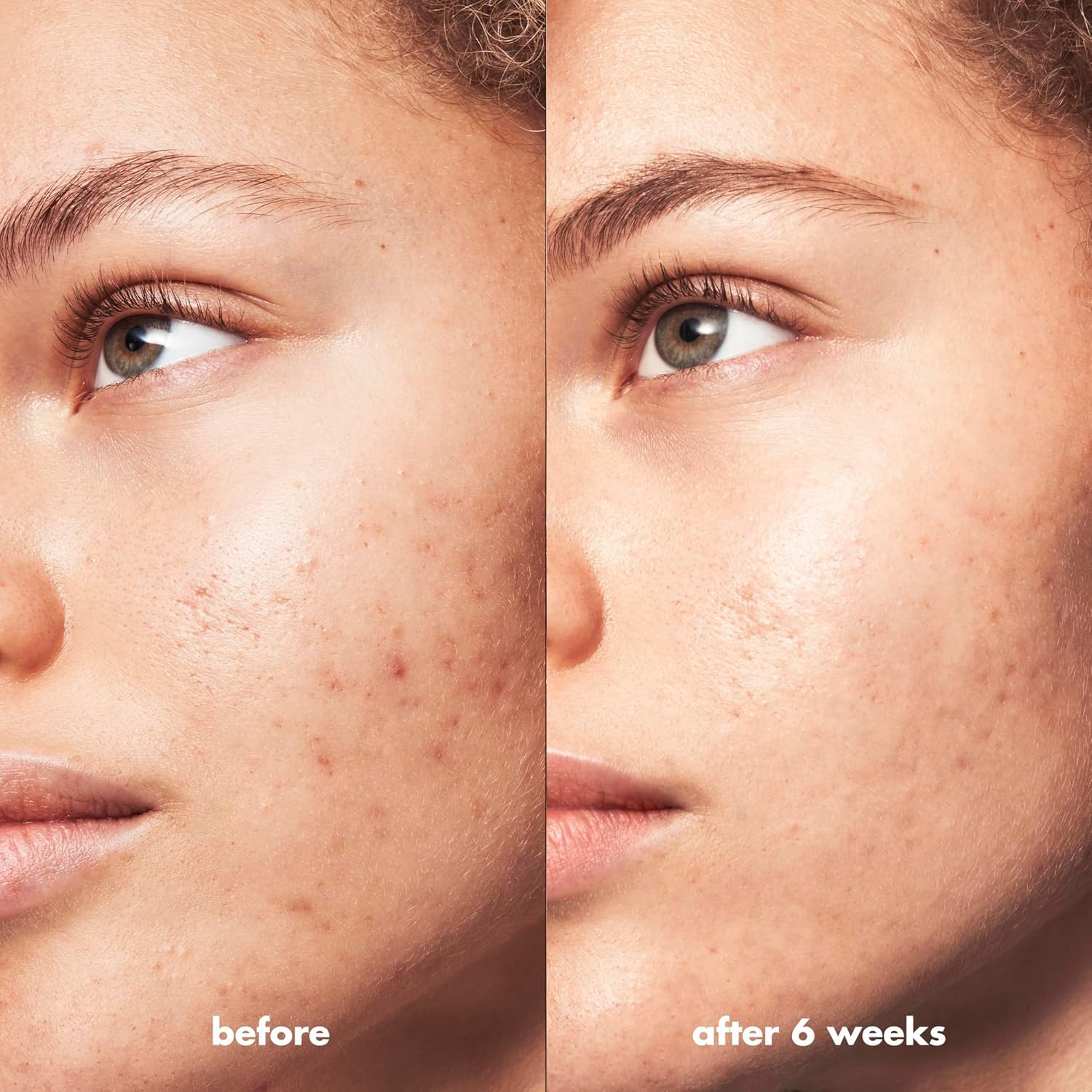 e.l.f. SKIN Blemish Breakthrough Calming Water Cream, Lightweight Blemish-Fighting Face Moisturiser, Prevents New Blemishes & Calms Skin - Image 5