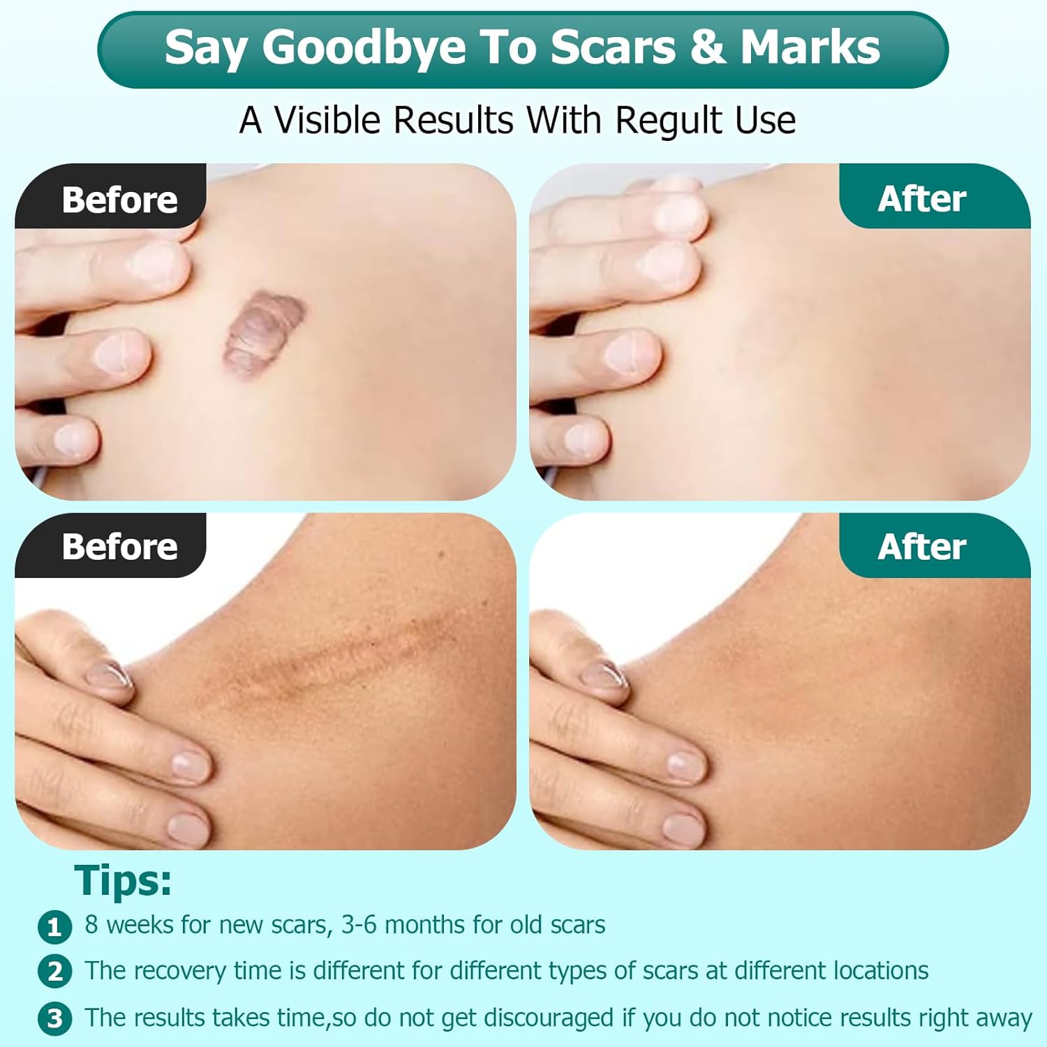 Advanced Scar Gel Cream for Surgical Scars, Burns, Acne, Stretch Marks, 1.76oz - Image 4