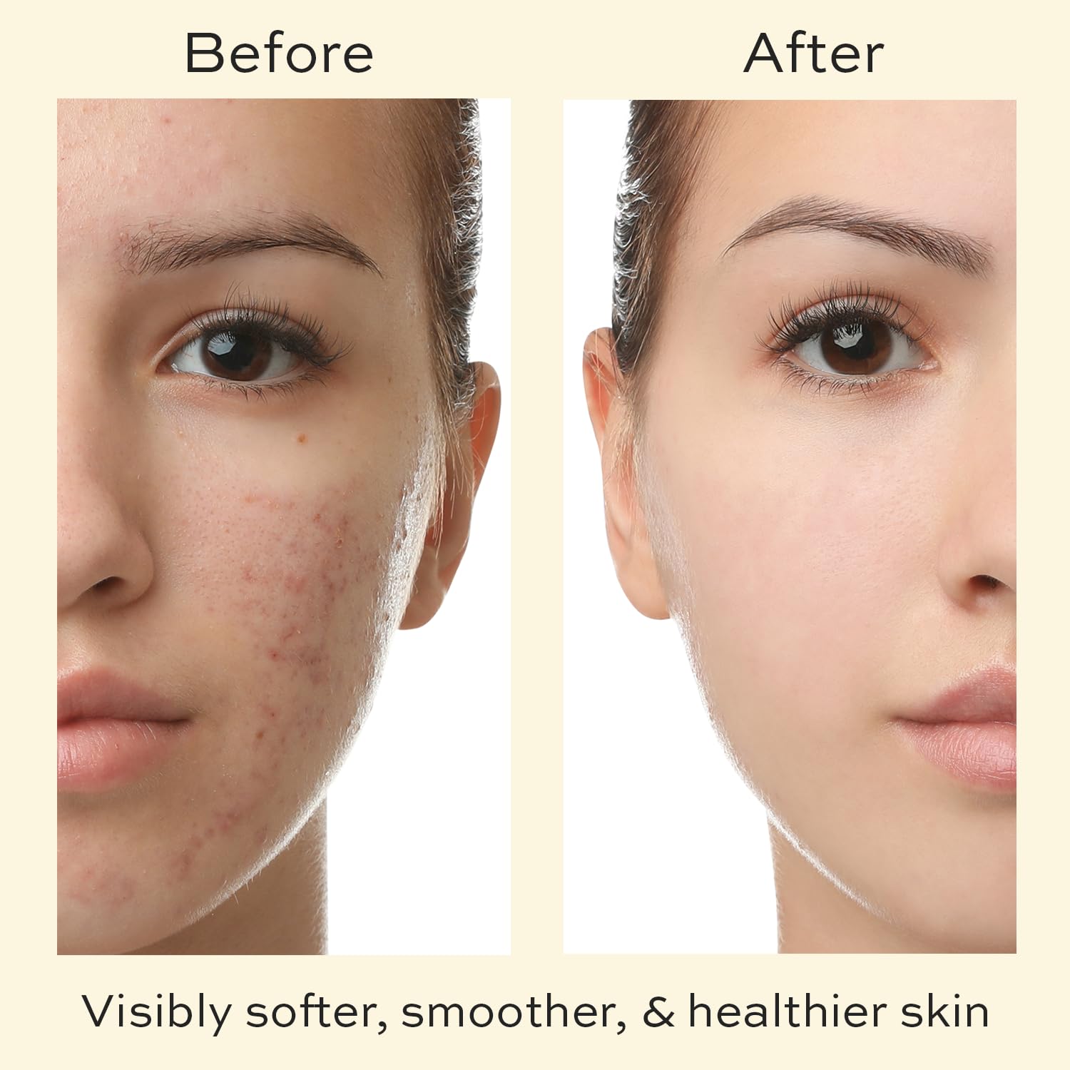 Skin Care for Teenage Boys and Girls - Teen Moisturizer for Face with Tea Tree - Organic Face Cream for Oily Skin - Daily Acne Treatment for Teenagers - Soothing Hyaluronic Acid Moisturizer - Image 5