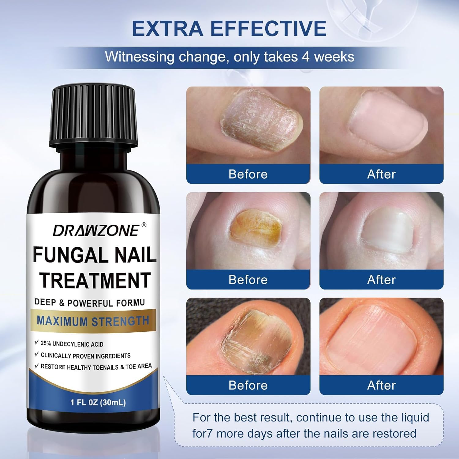 Extra Strength Toenail Fungus Treatment 25% Undecylenic Acid 30ml Damaged Nail Solution - Image 4