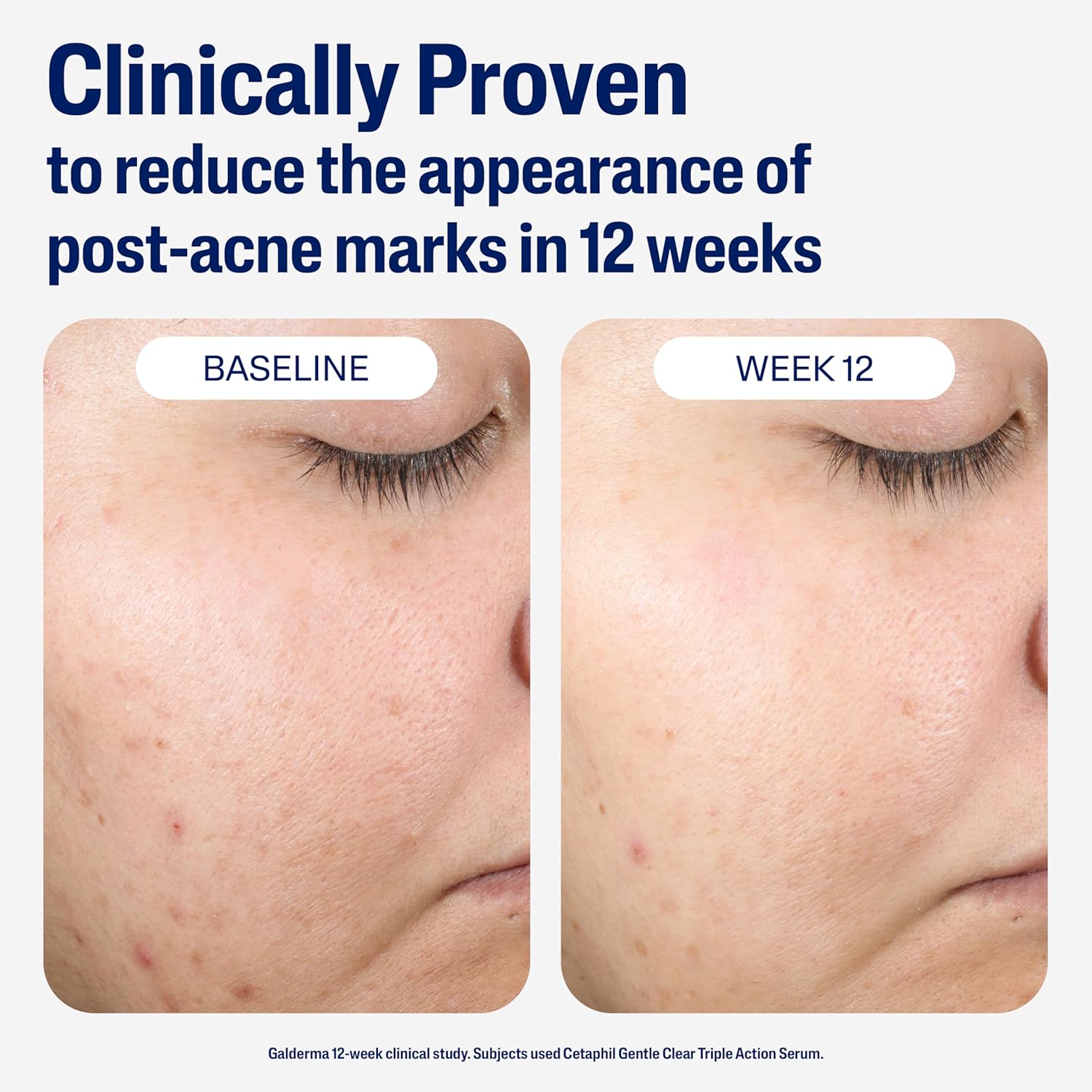 CETAPHIL Gentle Clear Repairing Post-Acne Serum, Retinol Alternative, Oil Free Serum for Sensitive Skin, 1 Fl Oz, Bakuchiol, Improves Skin Tone & Post-acne Marks, Dermatologist Recommended Brand - Image 5