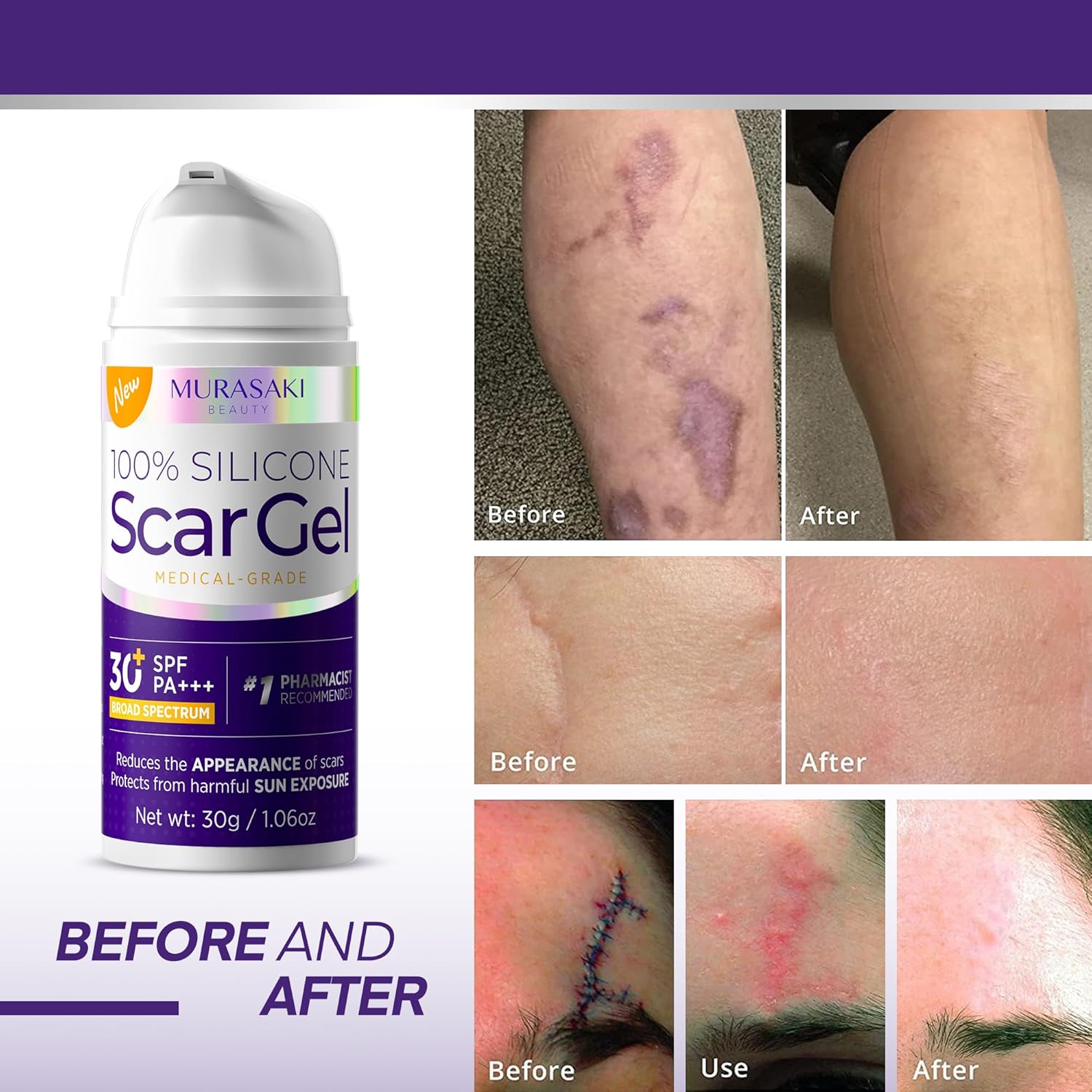 Silicone Scar Gel Scar Cream: SPF 30 Advanced Medical-Grade Formula for Surgical Scars, C-Section, Stretch Marks, Acne, Burns, Keloids, Old & New Scars – Broad Spectrum UV Protection 1.06oz (30g) - Image 2