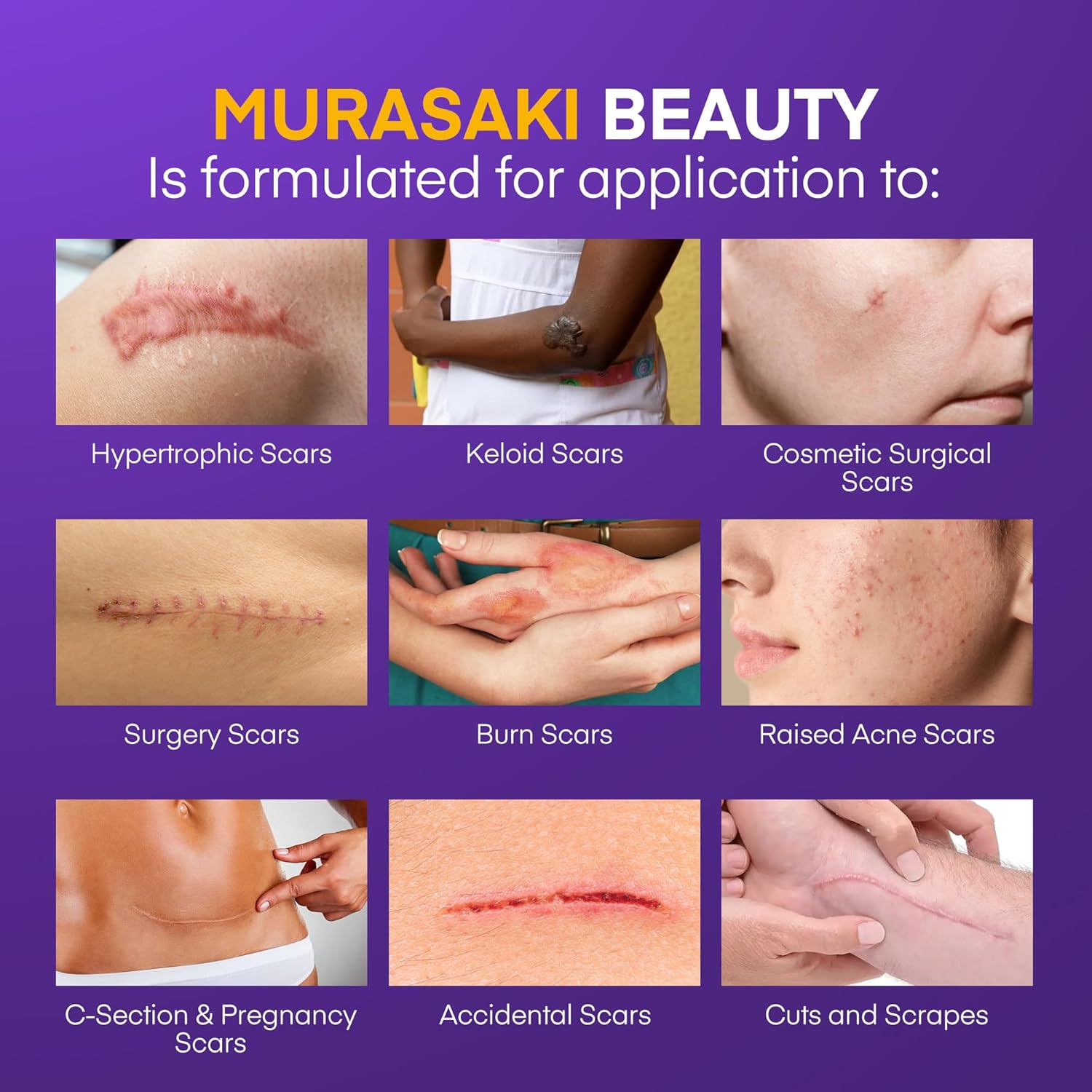 Silicone Scar Gel Scar Cream: SPF 30 Advanced Medical-Grade Formula for Surgical Scars, C-Section, Stretch Marks, Acne, Burns, Keloids, Old & New Scars – Broad Spectrum UV Protection 1.06oz (30g) - Image 3