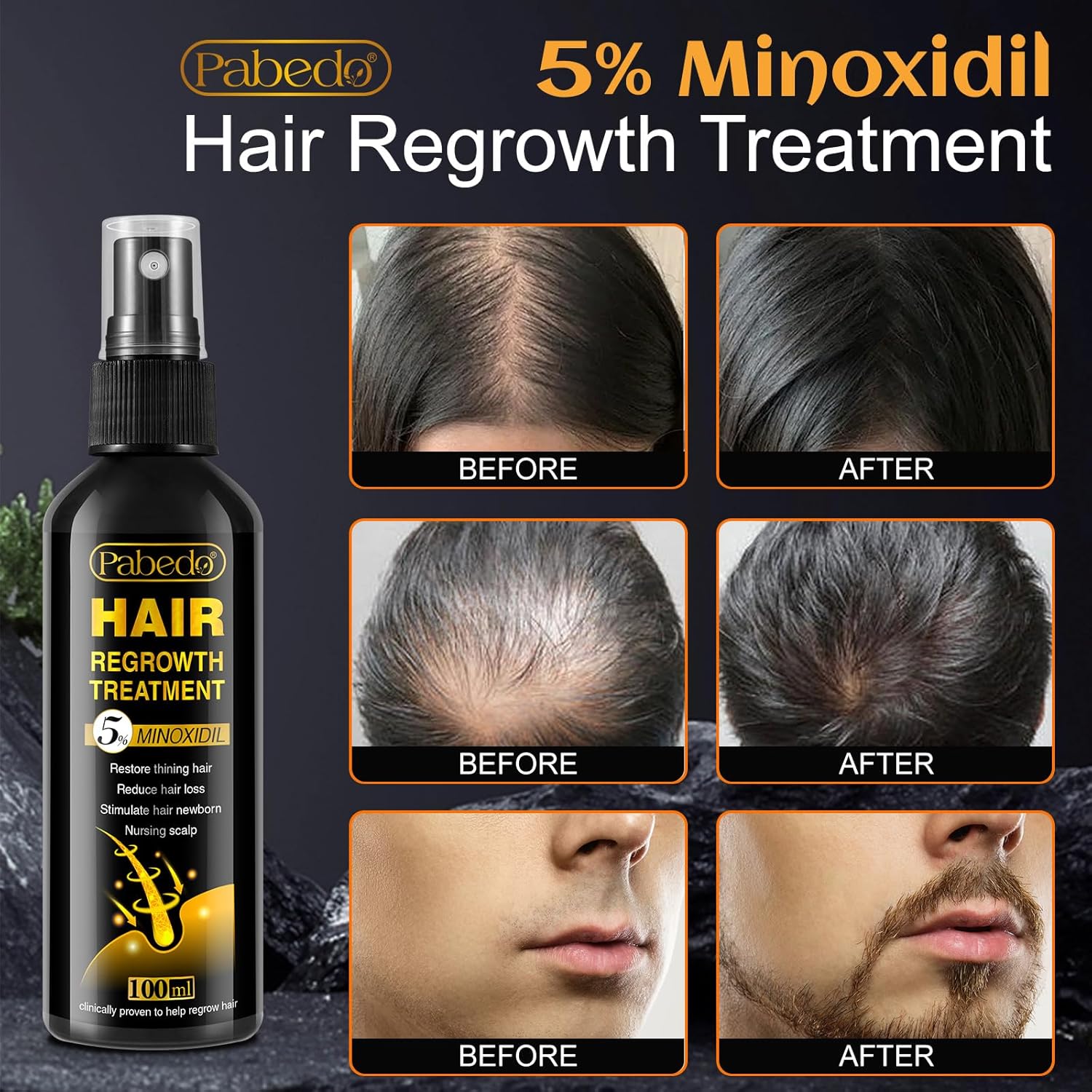 Nourish & Grow: 5% Minoxidil Hair Serum with Castor Oil & Biotin, 100ml, for Men & Women - Image 2