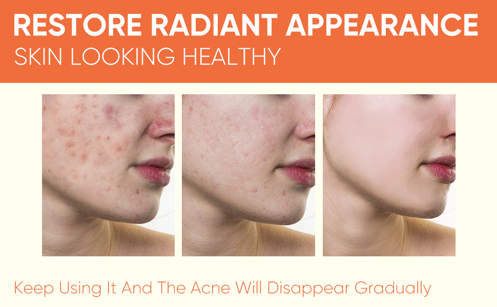 acne cream for body different gel acne treatment pimple cream for face buttocks acne cream