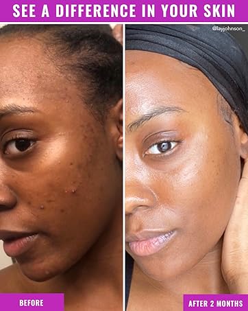 Good Molecules before/after results