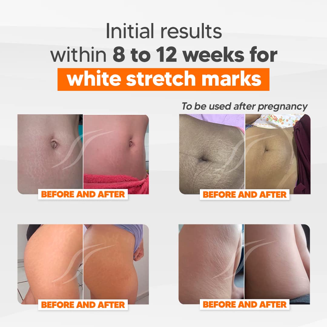 Cicatrissim Deep Stretch Mark Removal Cream - Innovative Formula With Pure and Powerful Natural Ingredients From Brazilian Flora - For All Stretch Marks & Skin Types. - Image 6