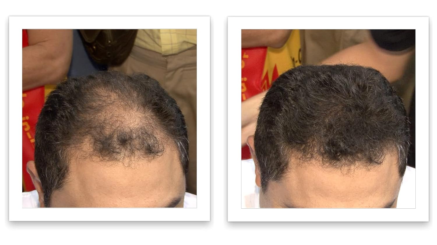Hair Loss Concealer. Cover Bald Spot and Thinning Hair Instantly. Make Thin Hair Look 10X Fuller. All-Natural Hair Building Fiber. Trial Size (10-Day Supply). Dark Brown - Image 6