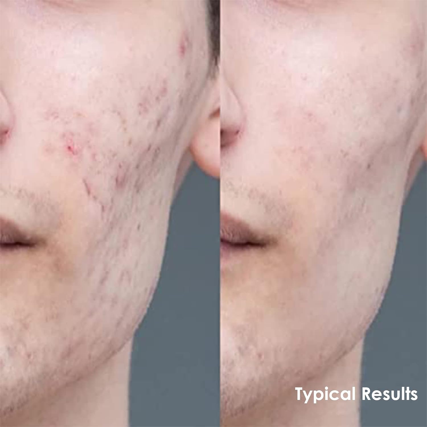 Tinted Moisturizer for Men by Apricus Skincare | Face Moisturizer Anti Aging and Anti-Redness | Dark Spot Concealer Cream and Redness Corrector | Matte Acne Face Moisturizer, 0.67 Oz, (Medium) - Image 6