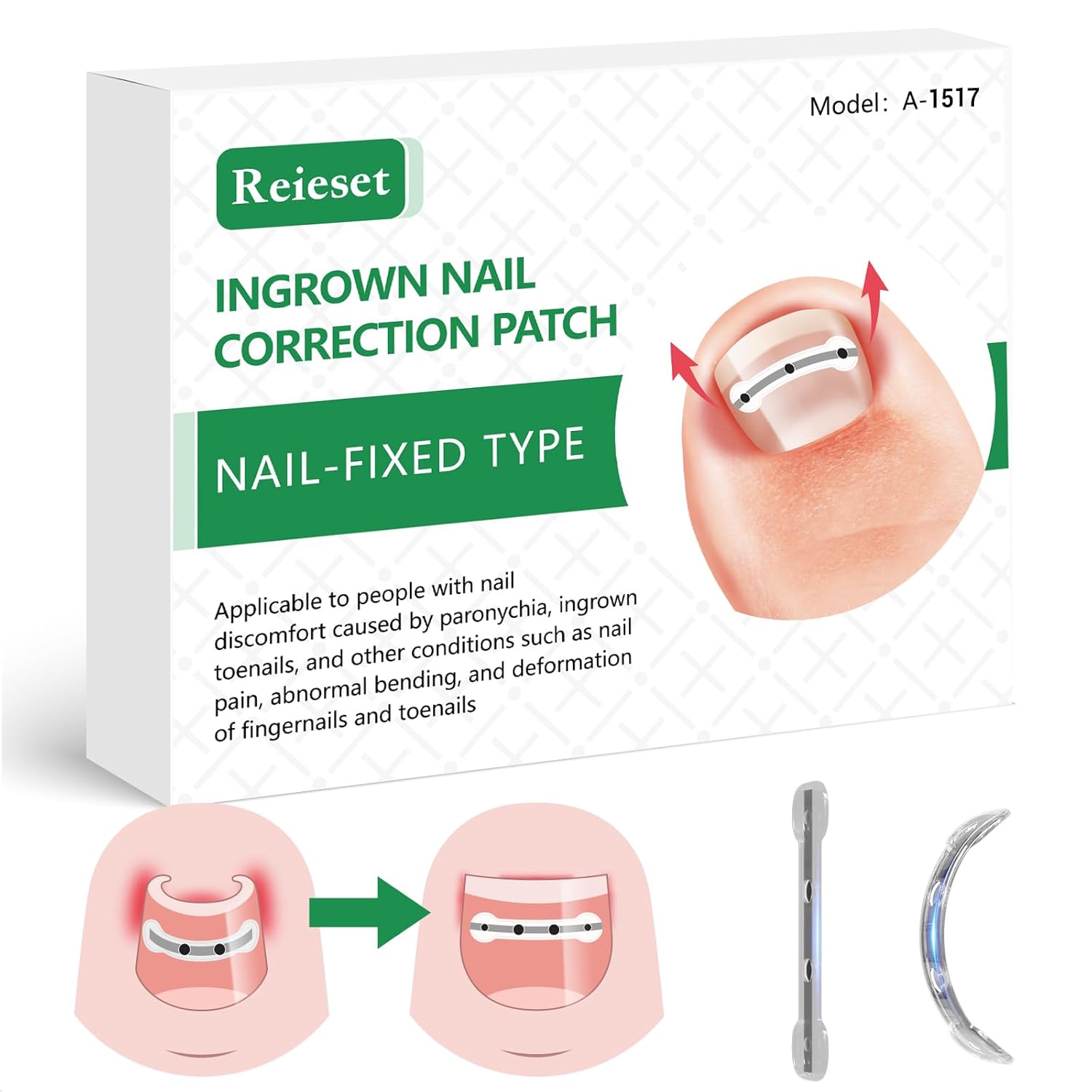 Titanium Alloy Ingrown Toenail Treatment, Nail Tools, and Ingrown Toenail Removal Kit Specially Designed for Curved Nail Repair and Ingrown Toenail Corrector(0.59/0.67in)