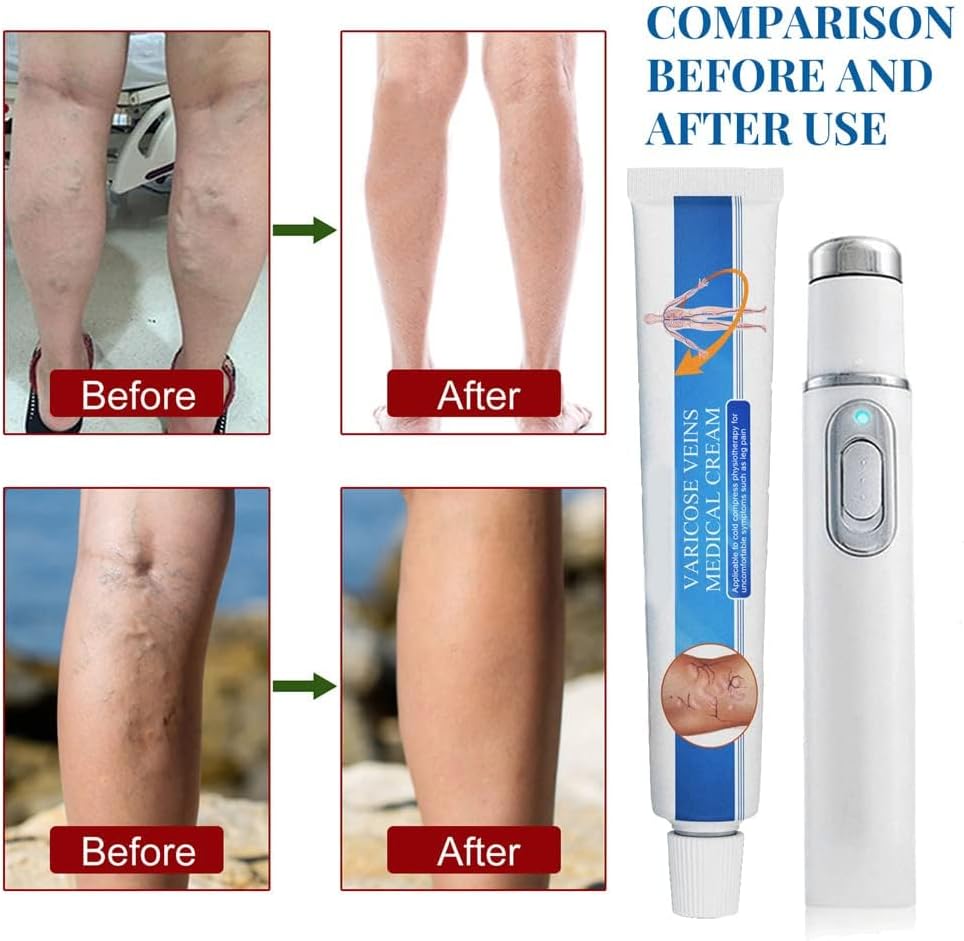 Vericose Veins Treatment Blue Light Lazer Treatment Pen,Spider Vein Treatment for Legs,Varicose Veins Blue Light Therapy Set - Image 7