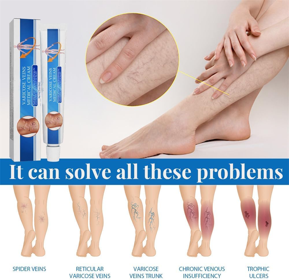 Vericose Veins Treatment Blue Light Lazer Treatment Pen,Spider Vein Treatment for Legs,Varicose Veins Blue Light Therapy Set - Image 5