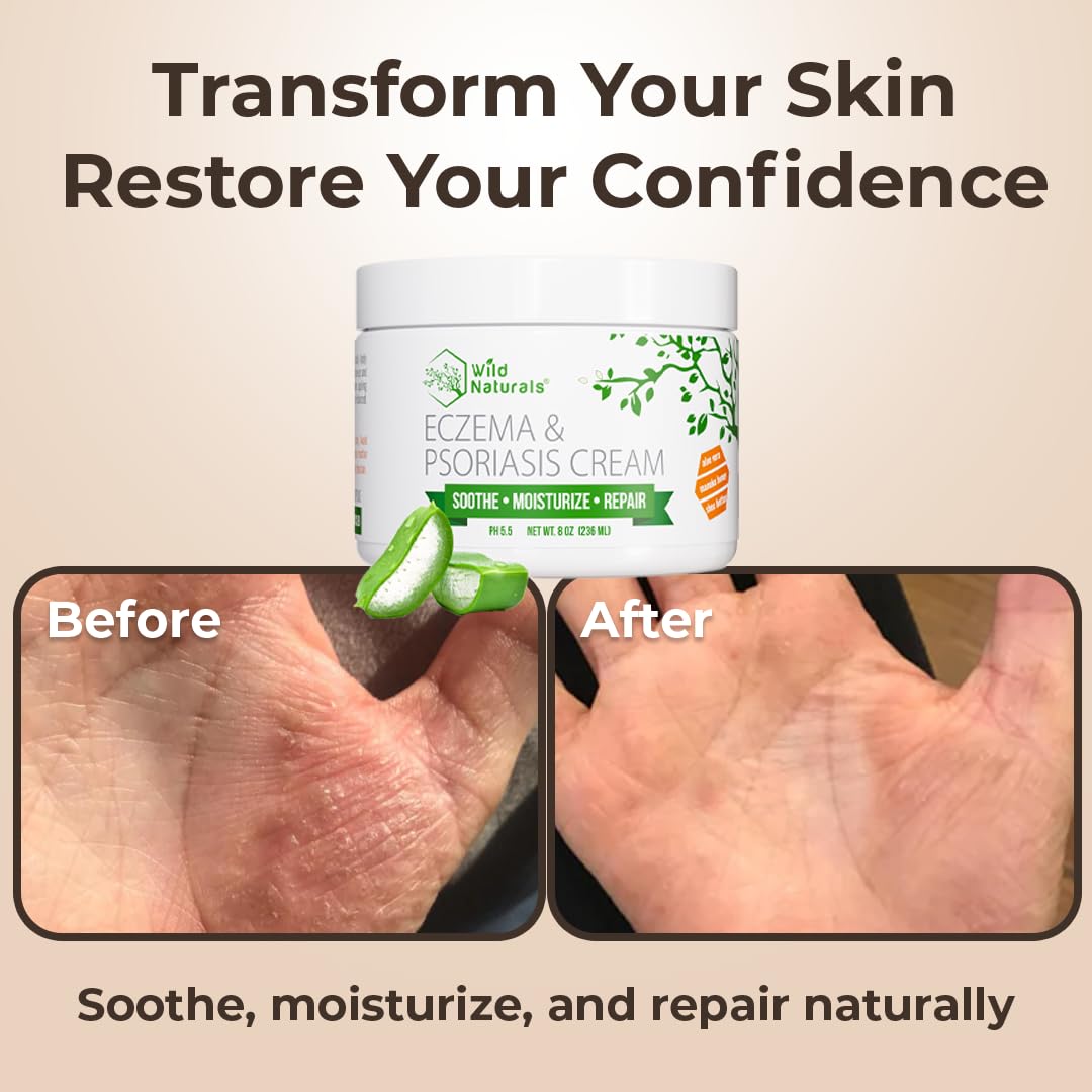 Wild Naturals Eczema & Psoriasis Cream for Dry, Itchy Skin – Eczema Relief for Adults & Kids – Moisturizing Psoriasis Cream with Manuka Honey - Image 5