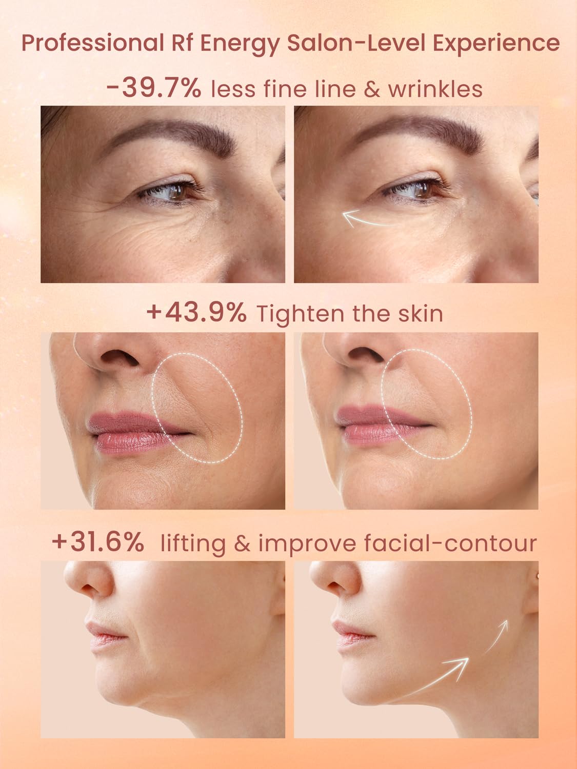 Professional Wireless RF Skin Tightening Device for Anti-Aging, Lifting and Firming, 3 Levels - Image 3