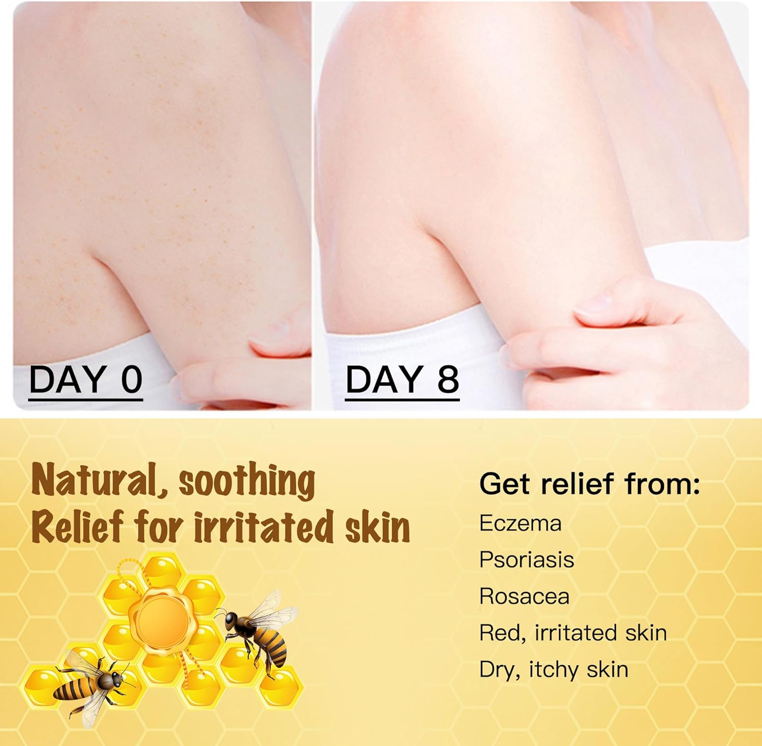 Manuka Honey Bee Venom Eczema Cream Natural Dry Skin Relief Moisturizer 4 oz - Image 4
