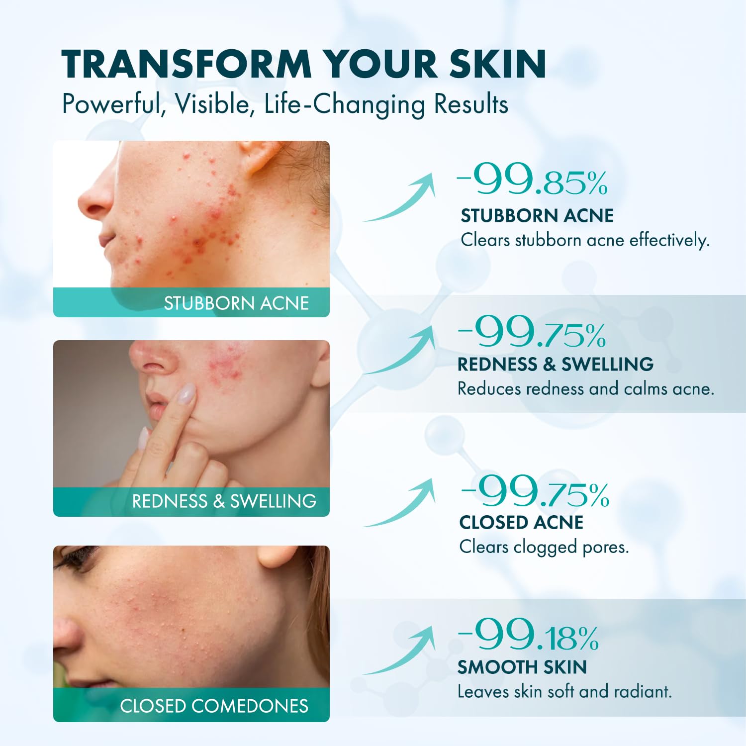 Rossy 12% Azelaic Acid Acne Cream 50ml Daily Anti-Blemish Facial Treatment for All Skin Types - Image 4