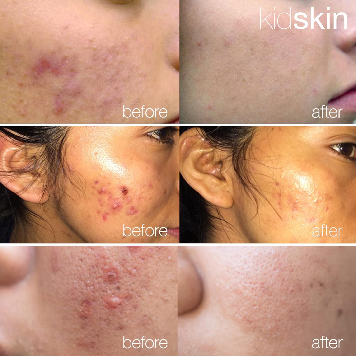 Kidskin Z-Blast Vegan Face Acne Serum for Kids Ages 9-17, 1 fl oz - Image 5