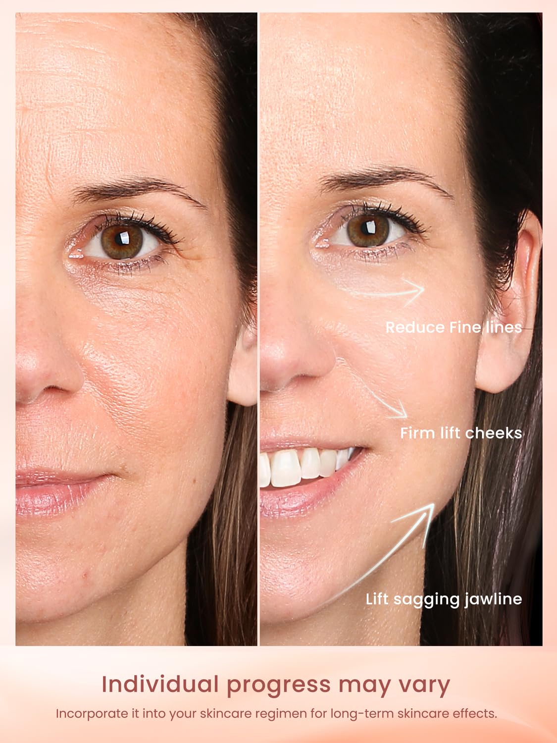 Professional Wireless RF Skin Tightening Device for Anti-Aging, Lifting and Firming, 3 Levels - Image 4